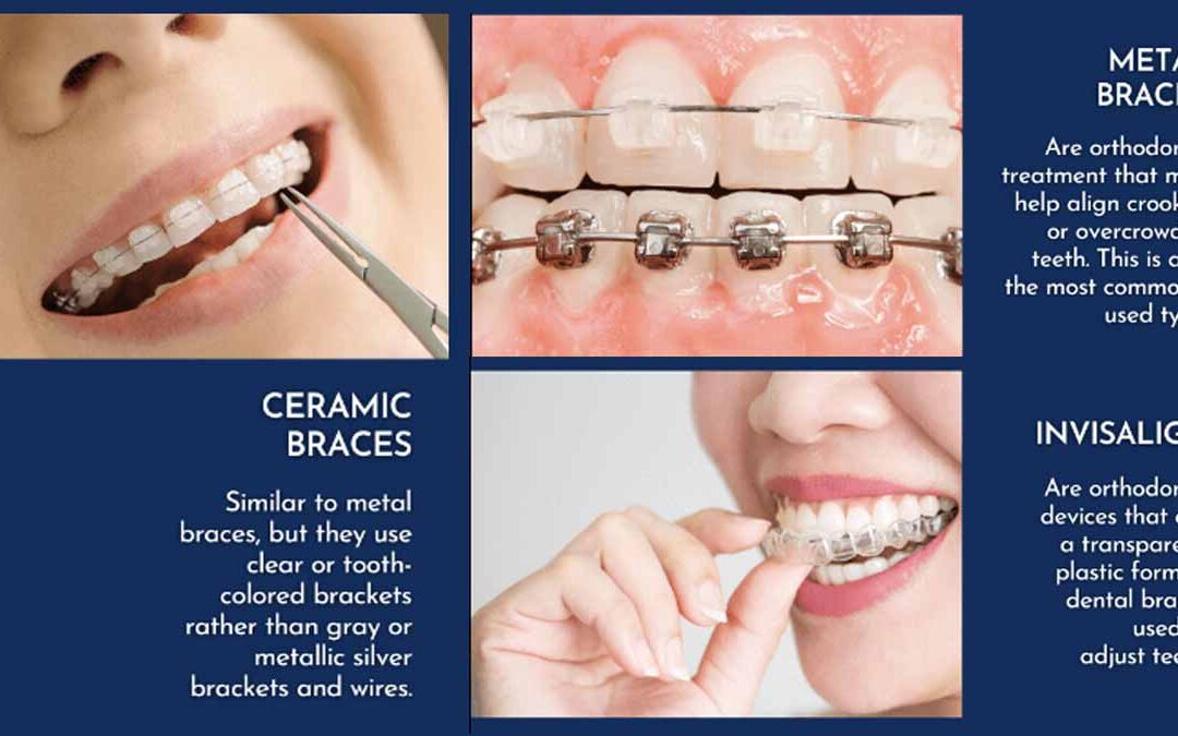 Dental Braces: Comparing Traditional Braces, Clear Braces, and Invisalign
