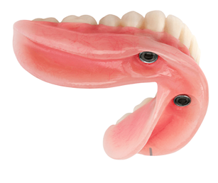 Mini Implant Dentures