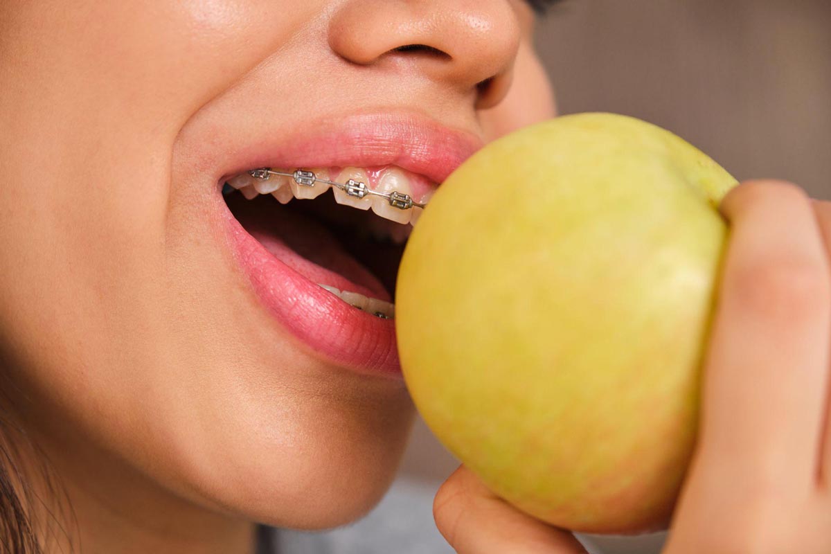 Some foods can pose a challenge to oral hygiene while wearing braces.